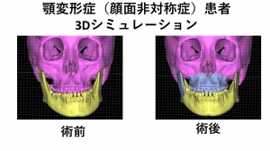 顎変軽症に対する外科矯正手術.jpg